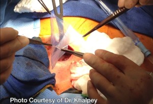 Dr. Zain Khalpey places the amniotic patch onto the heart of a cardiac patient at the University of Arizona Medical Center.