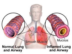 Ilustración de una vía respiratoria pulmonaria normal comparada con una vía respiratoria pulmonaria inflamada (Foto por: Blausen.com. “Blausen gallery 2014”)