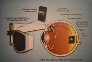 An overview of the retinal implant that uses the processing unit or iPhone/iPod to capture and process images and then transmit the information to an implanted microelectronic system. The implant decodes the data and stimulates the retina with a pattern of electrical impulses to produce visual perceptions.